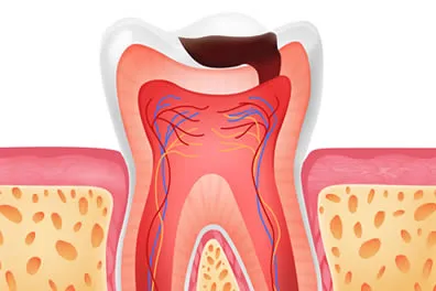 Tooth Colored Fillings