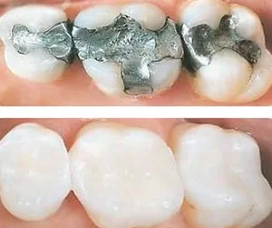 white-fillings-1 white fillings 1